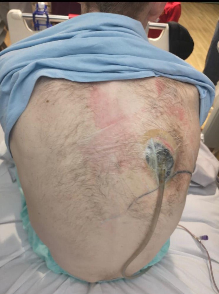 The wound on Richard Stephenson's back